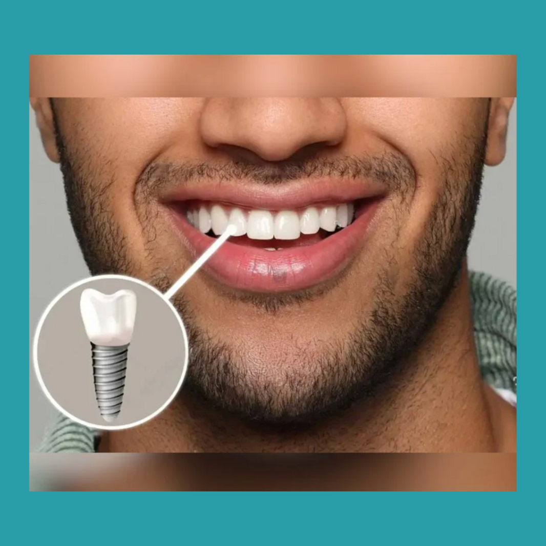 dental implants