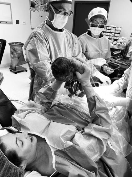 mother assisted cesarean birth