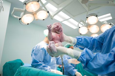 cesarean birth - baby just born