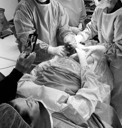 mother assisted cesarean birth