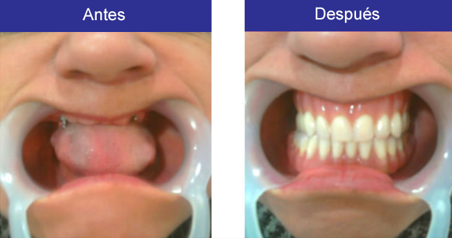 implantes-cigomaticos-diseno-sonrisa.png