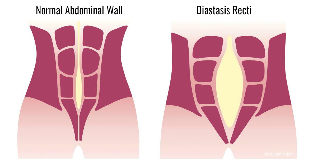 Diastasis Recti Abdominal Seperation Superfit mom