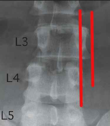 L3 vertebre xray renactment.jpg