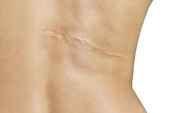 hypertrophic scar
