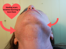 Healing scars involves learning to love them