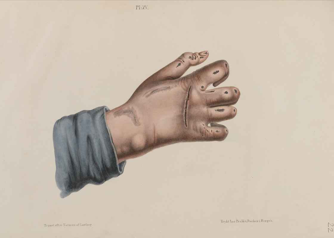 Hand_showing_leprosy_Wellcome_L0040719