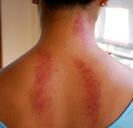 gua-sha-marks-back