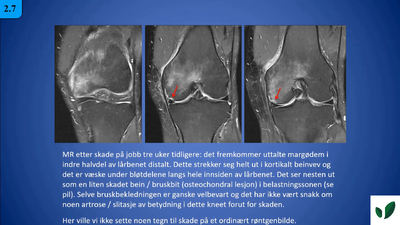 JK11 Bone bruise 2.7