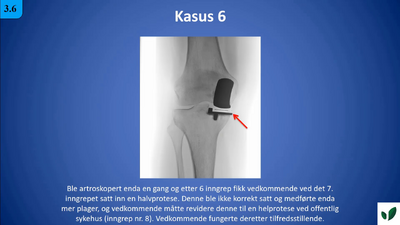 JK11 Kasus 6 Traume med god prognose ubehandlet men som medfører stor artrose et