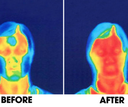 Before-after-thermographic-facial-image