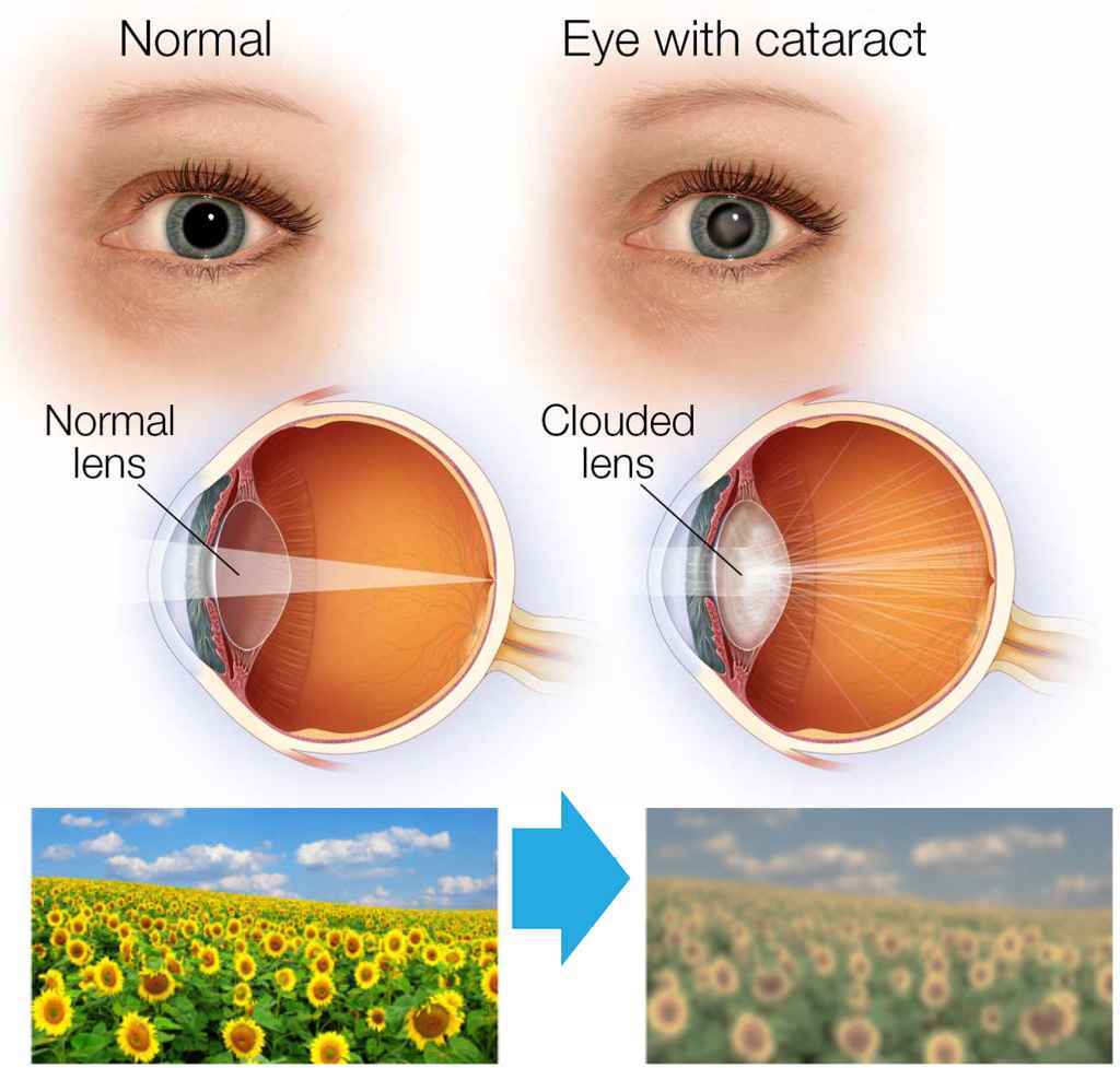 Cataract-cloudy-vision-1024w-977h