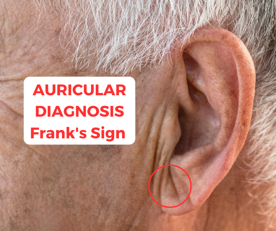 Auricular Diagnosis Frank's Sign